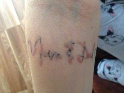 the dangers of non laser tattoo removal the new canvas the dangers of non laser tattoo removal the new canvas