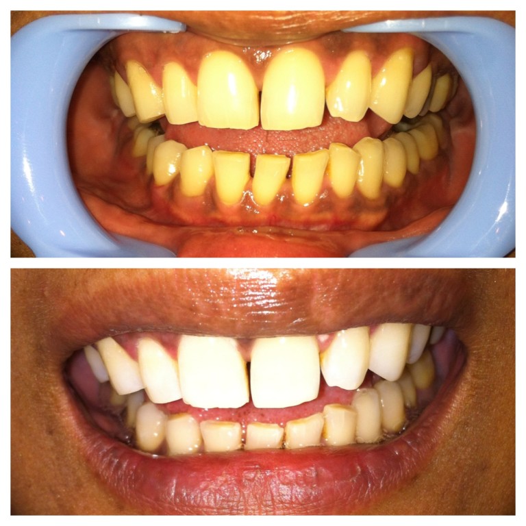 Laser Teeth Whitening After Three Sessions
