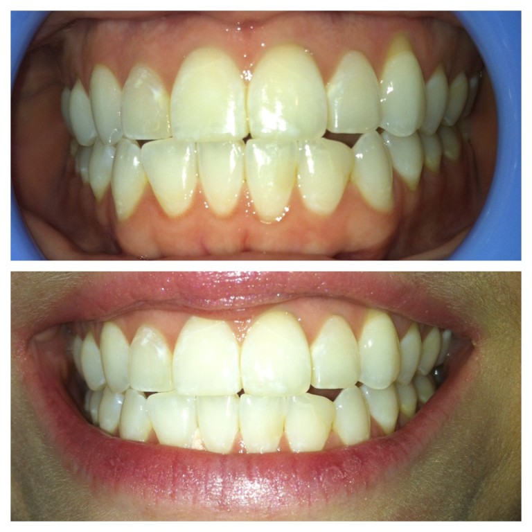 Laser Teeth Whitening After One Session