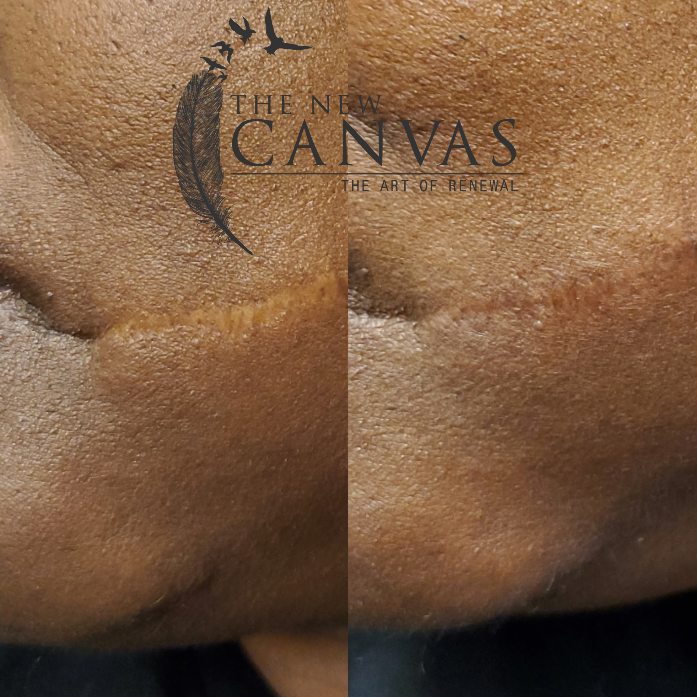 Scar & Stretchmark Treatment Colorado Springs | Brazilian Camouflage Tattoo  Artist | The New Canvas