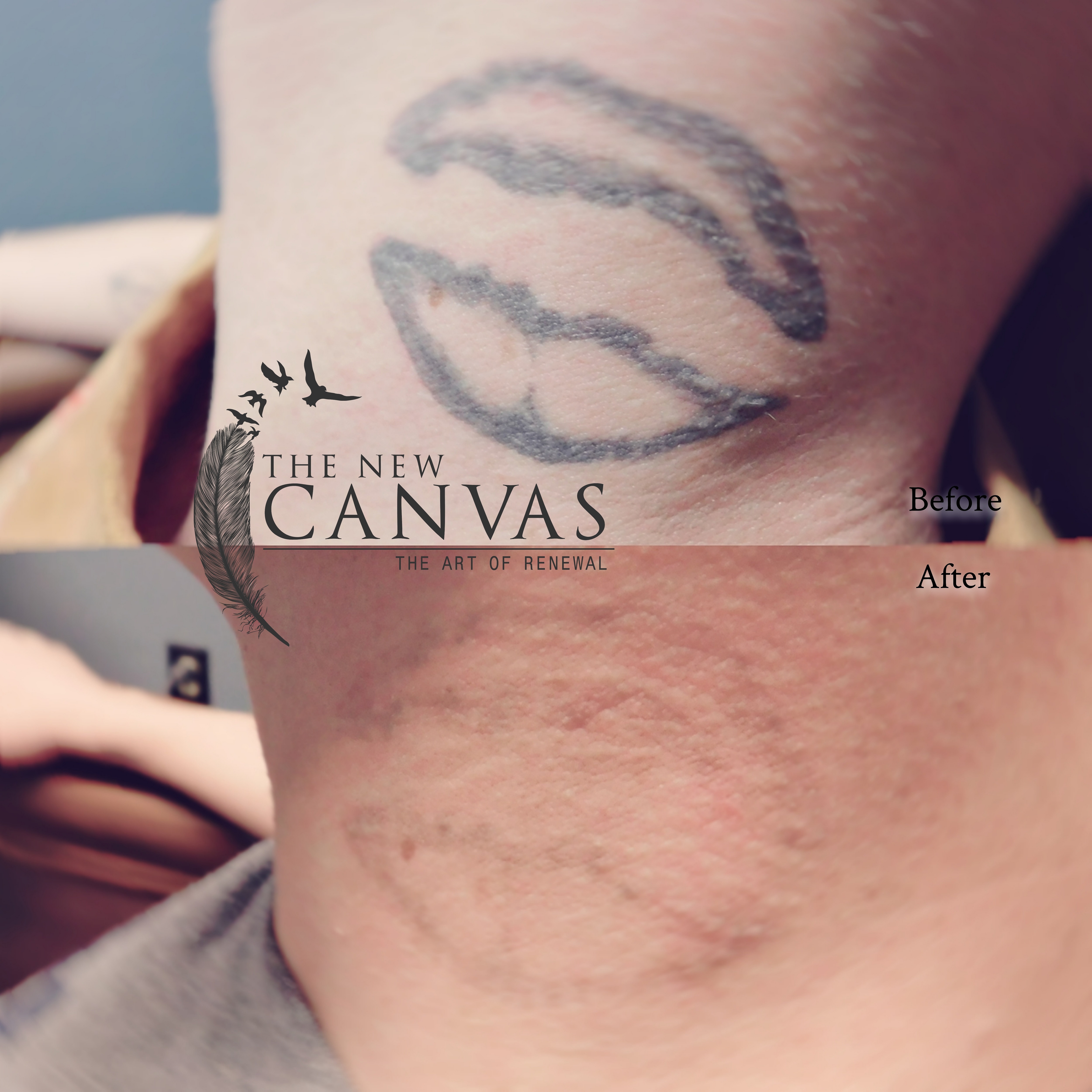 Best solutions for laser tattoo removal in Colorado springs by Certified  Tattoo Studios - Issuu