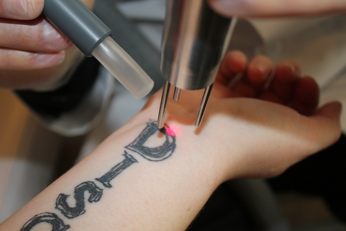 El Paso Laser Tattoo Removal  El Paso Cosmetic Surgery