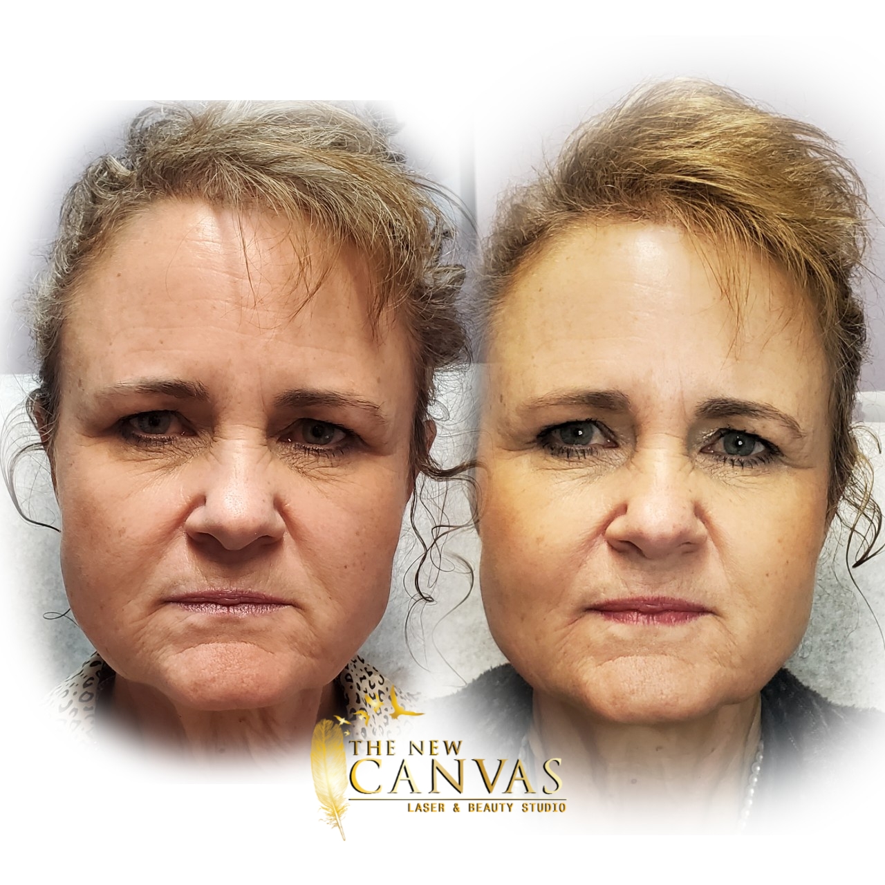 Plasma Fibroblast in Colorado Springs The New Canvas