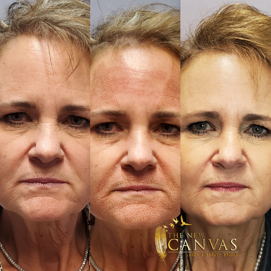 Plasma Fibroblast in Colorado Springs The New Canvas