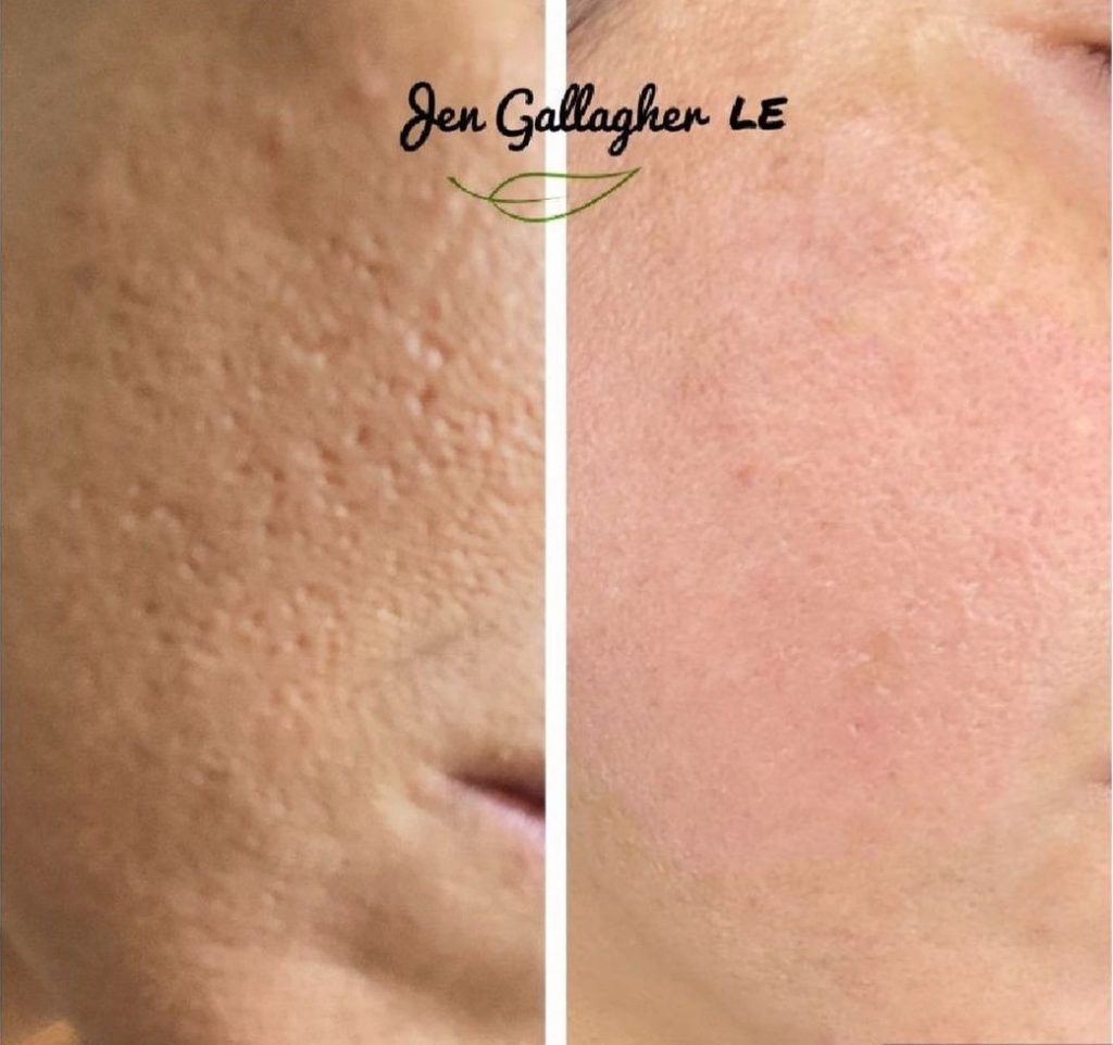 Plasma Fibroblast in Colorado Springs The New Canvas