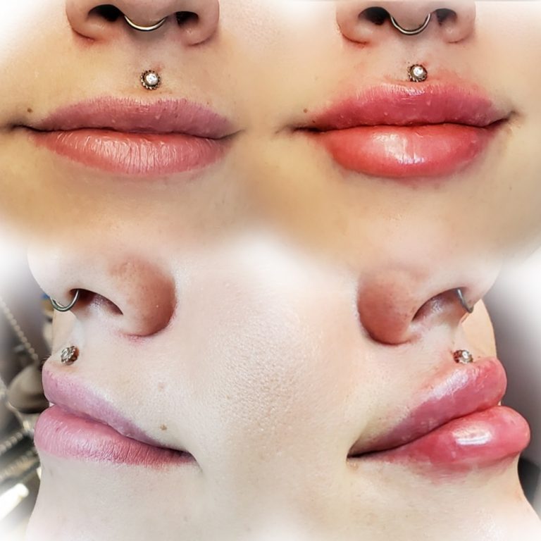 Lip Enhancement with Cosmetic Injectables