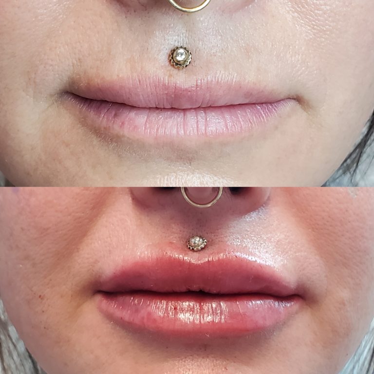 Lip Enhancement with Cosmetic Injectables